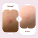 Maskeraide Invisible Acne Patches || 60 Patches